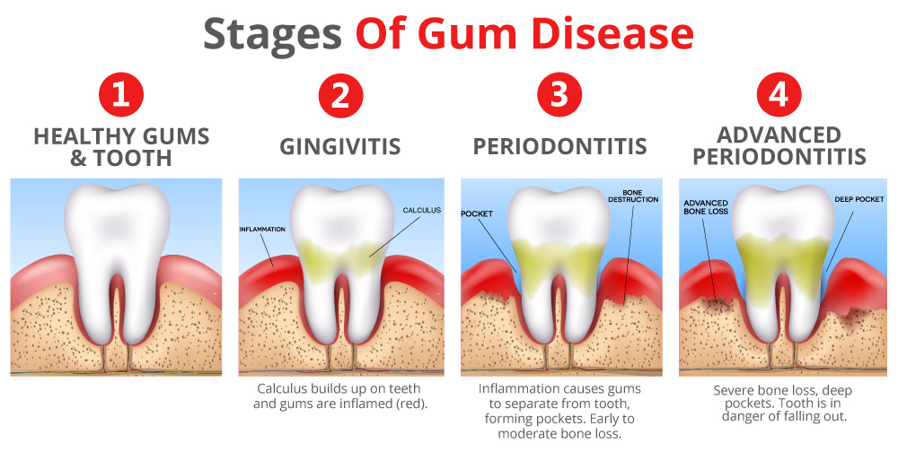 chronic diseases bacteria teeth gums