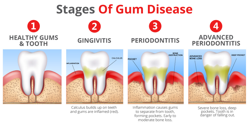 receding gums stages