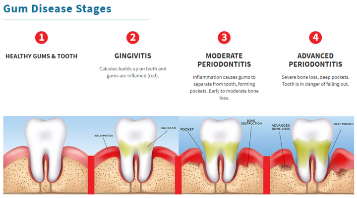 Gum-disease-stages - Fight Gum Disease