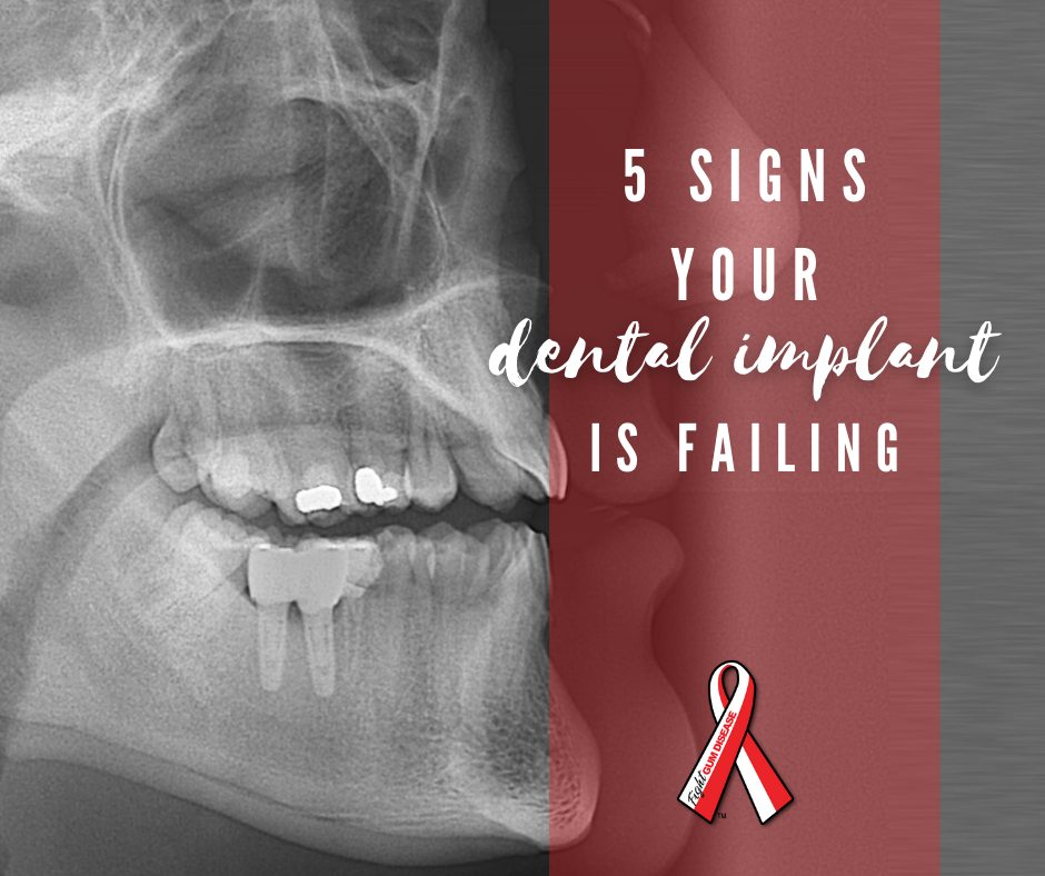 Top 5 Signs Your Dental Implant is Failing